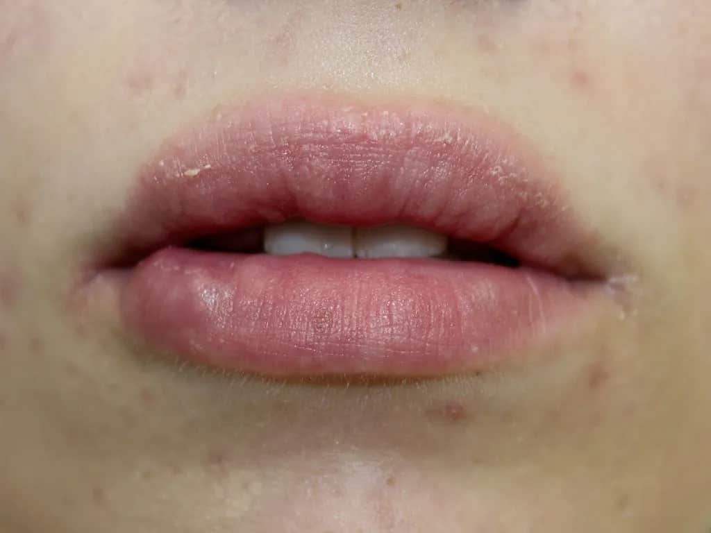 Co na opryszczkę po powiększaniu ust? Skuteczne metody leczenia