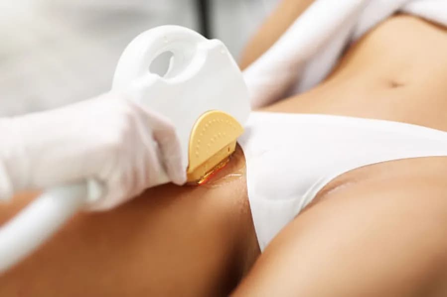 Jak przygotować się do depilacji laserowej bikini, aby uniknąć problemów