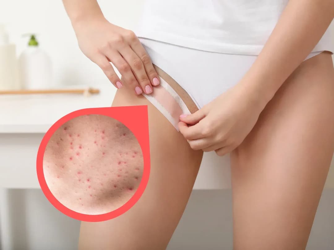 Jak pozbyć się kropek po goleniu - skuteczne sposoby na ulgę i zapobieganie