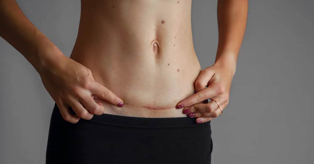 Kiedy można się golić po cesarce? Sprawdź, aby uniknąć bólu