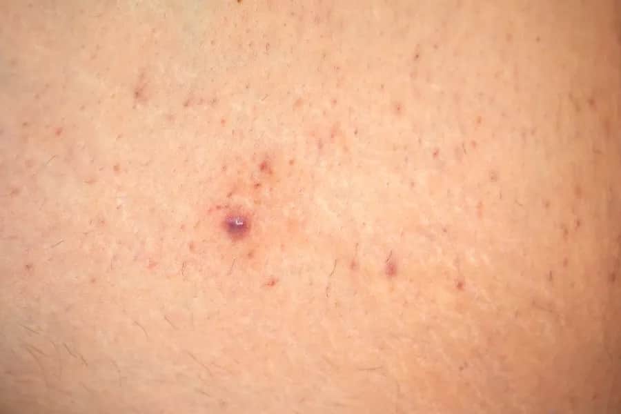 Jak wygląda zapalenie mieszków włosowych? Objawy, przyczyny i leczenie