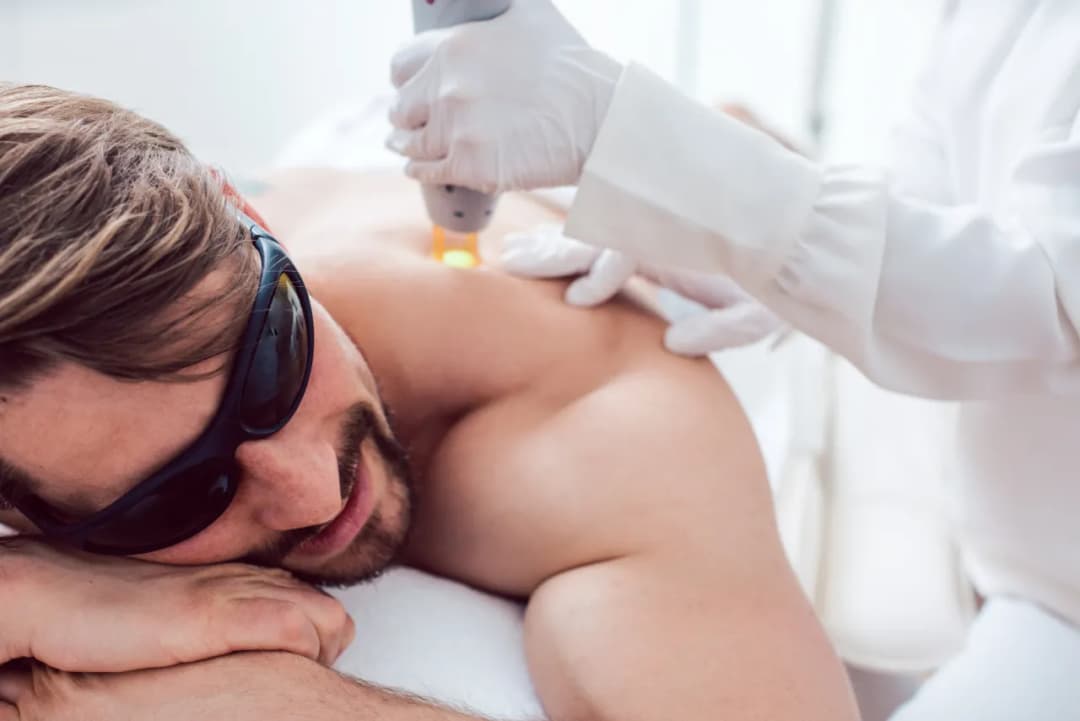 Kiedy robić depilację laserową, aby uniknąć poparzeń i przebarwień?